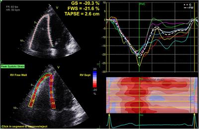 Prognostic value of right ventricular free wall strain in patients with sepsis